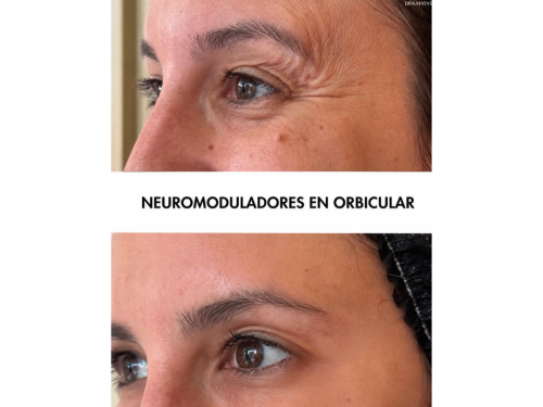 NEUROMODELADORES EN ORBICULAR