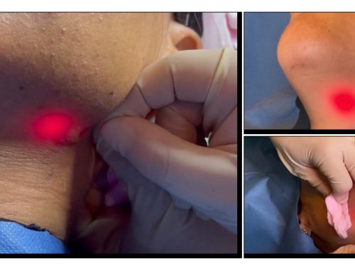 LÁSER ENDOLIFT