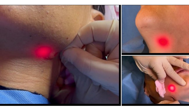 LÁSER ENDOLIFT